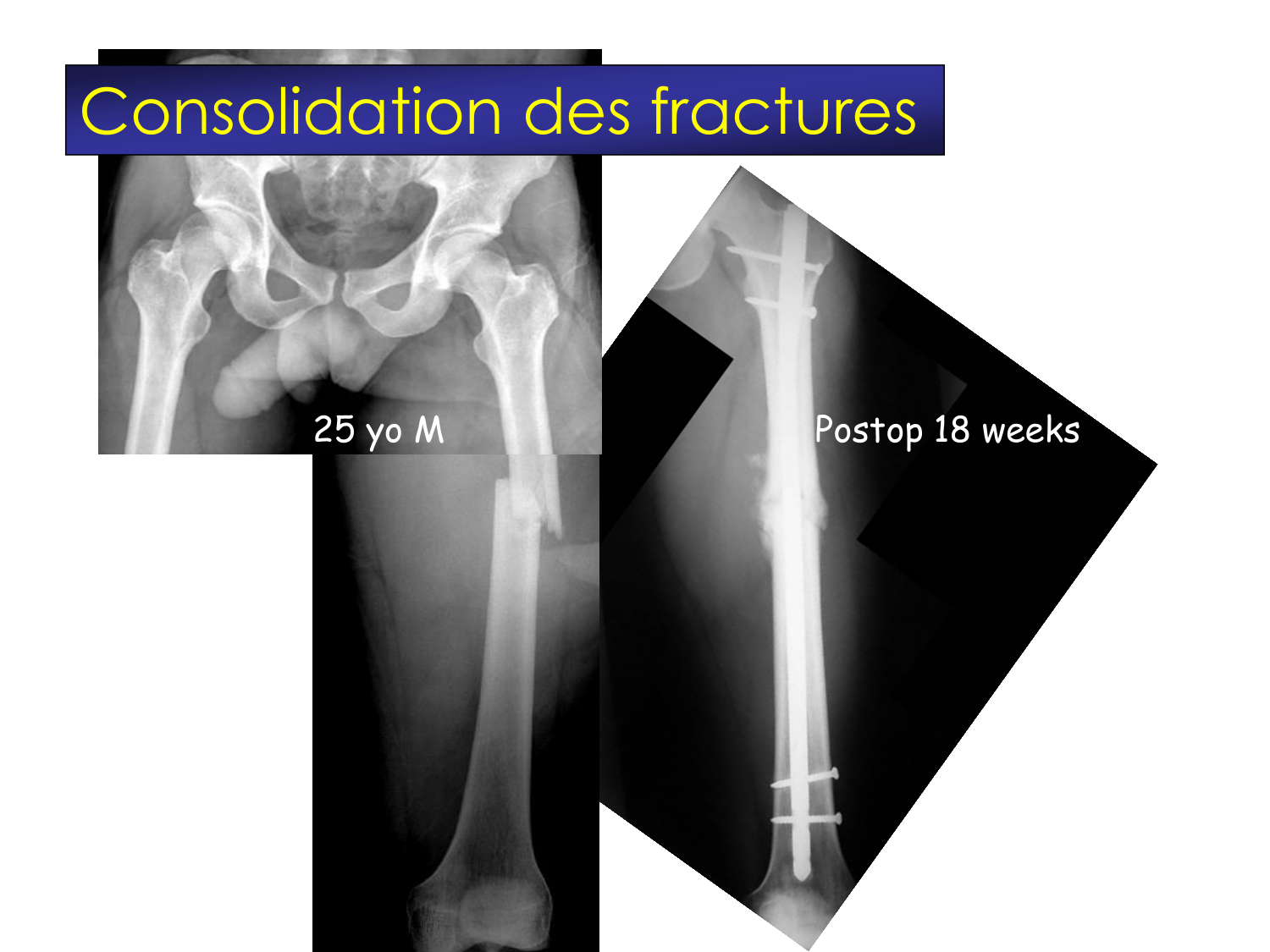 Fractures et réparation page 4