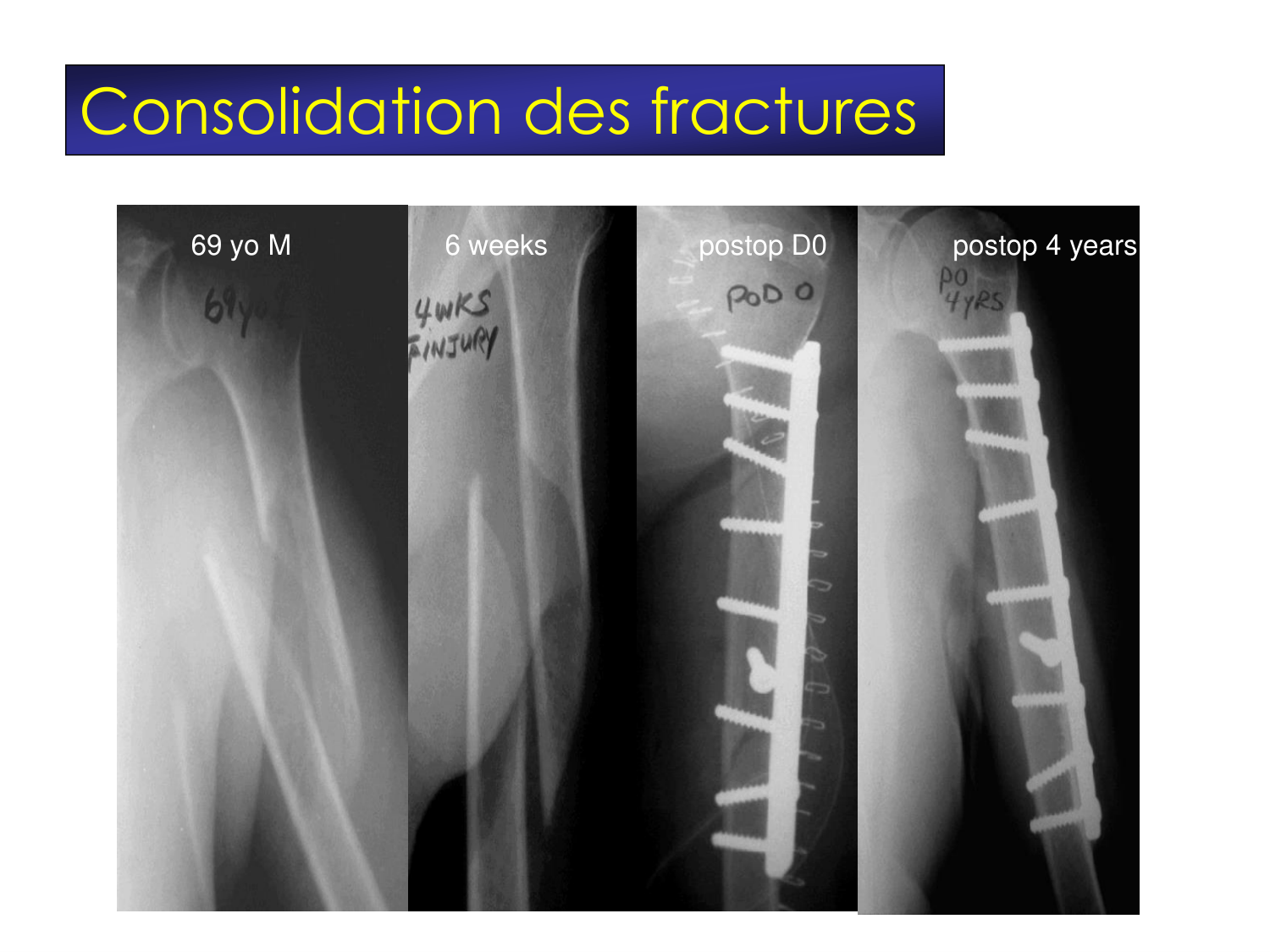 Fractures et réparation page 5