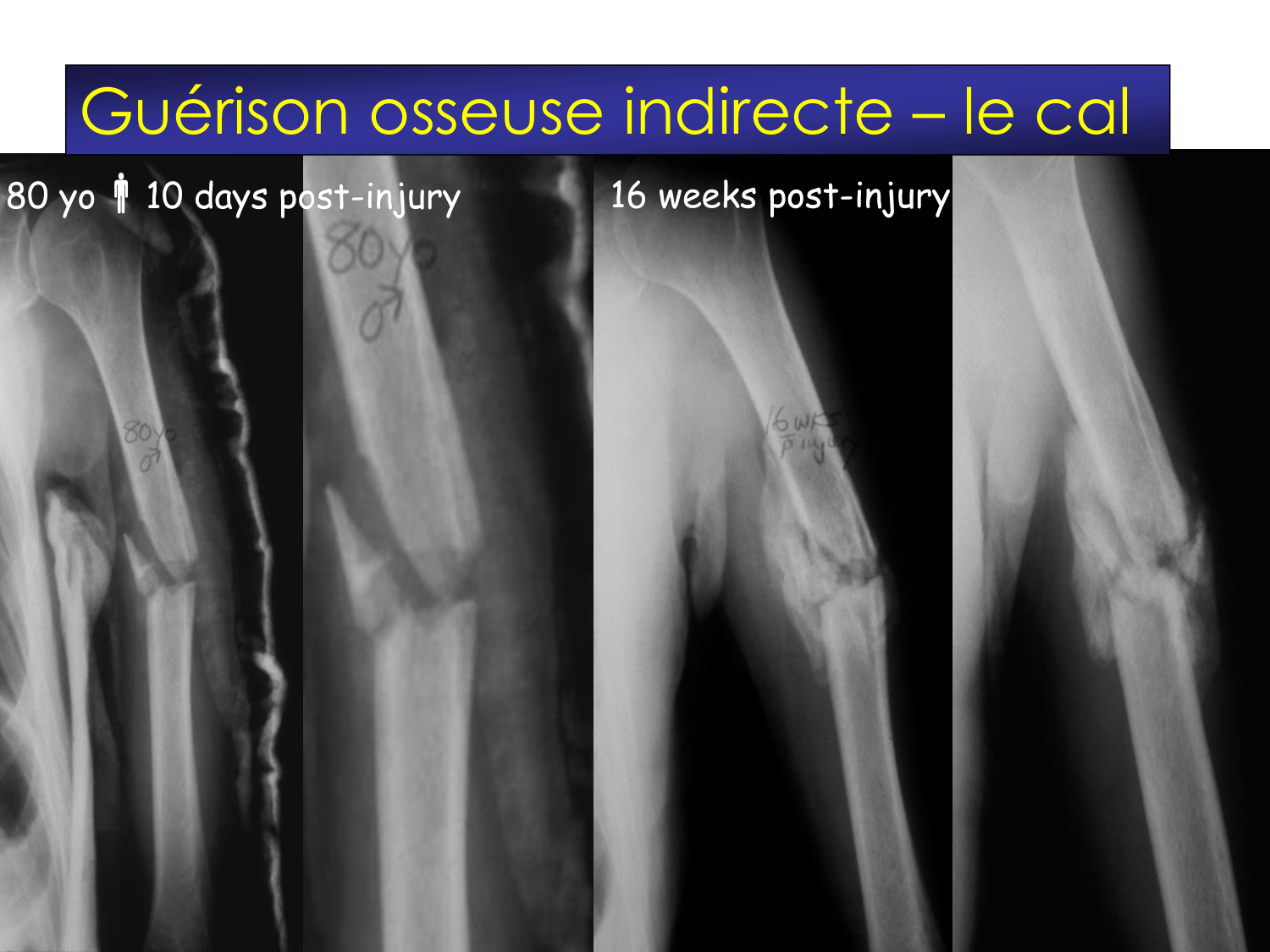 Fractures et réparation page 14