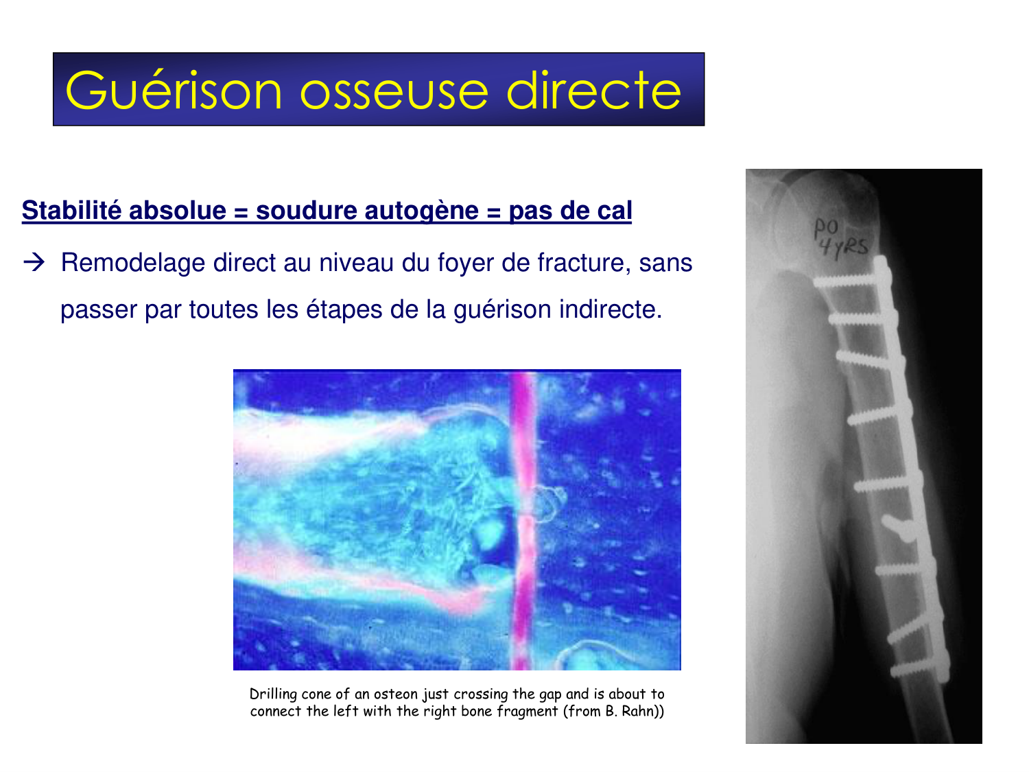 Fractures et réparation page 15