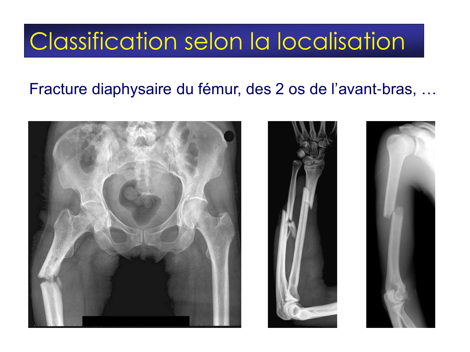 Fractures et réparation page 20