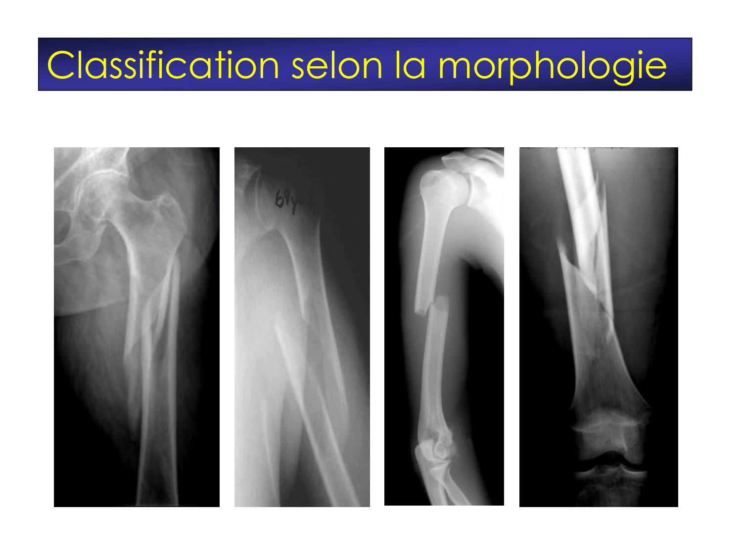 Fractures et réparation page 22