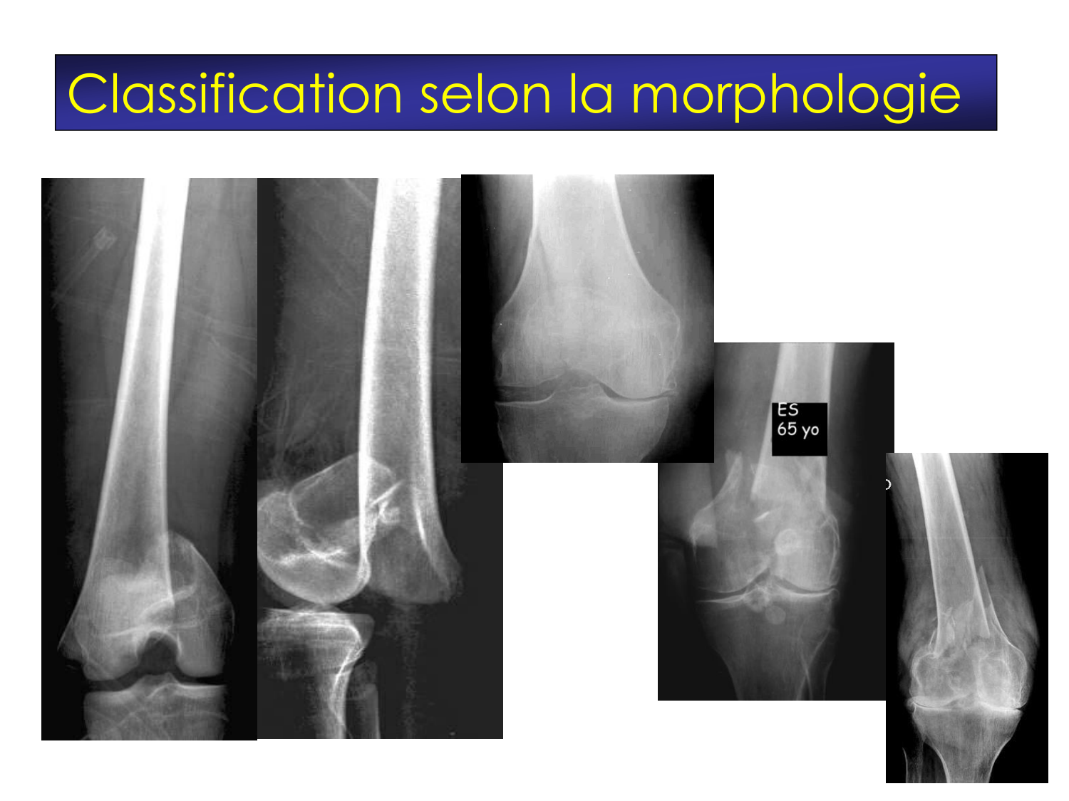 Fractures et réparation page 24