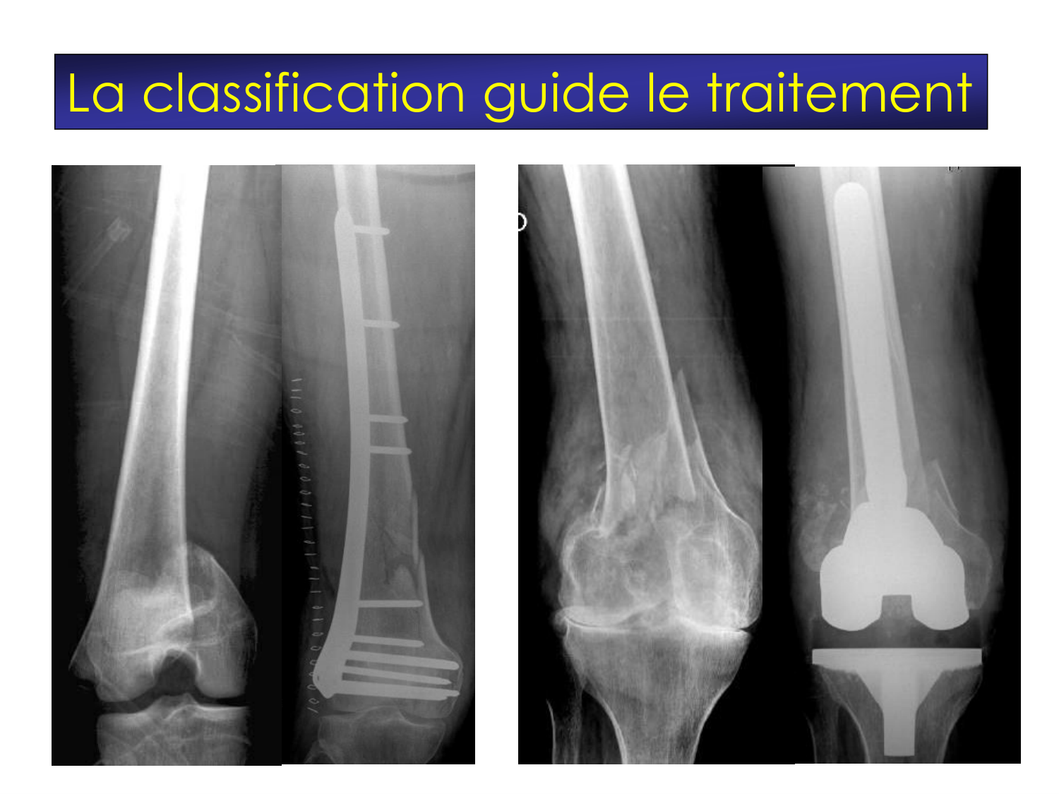 Fractures et réparation page 25