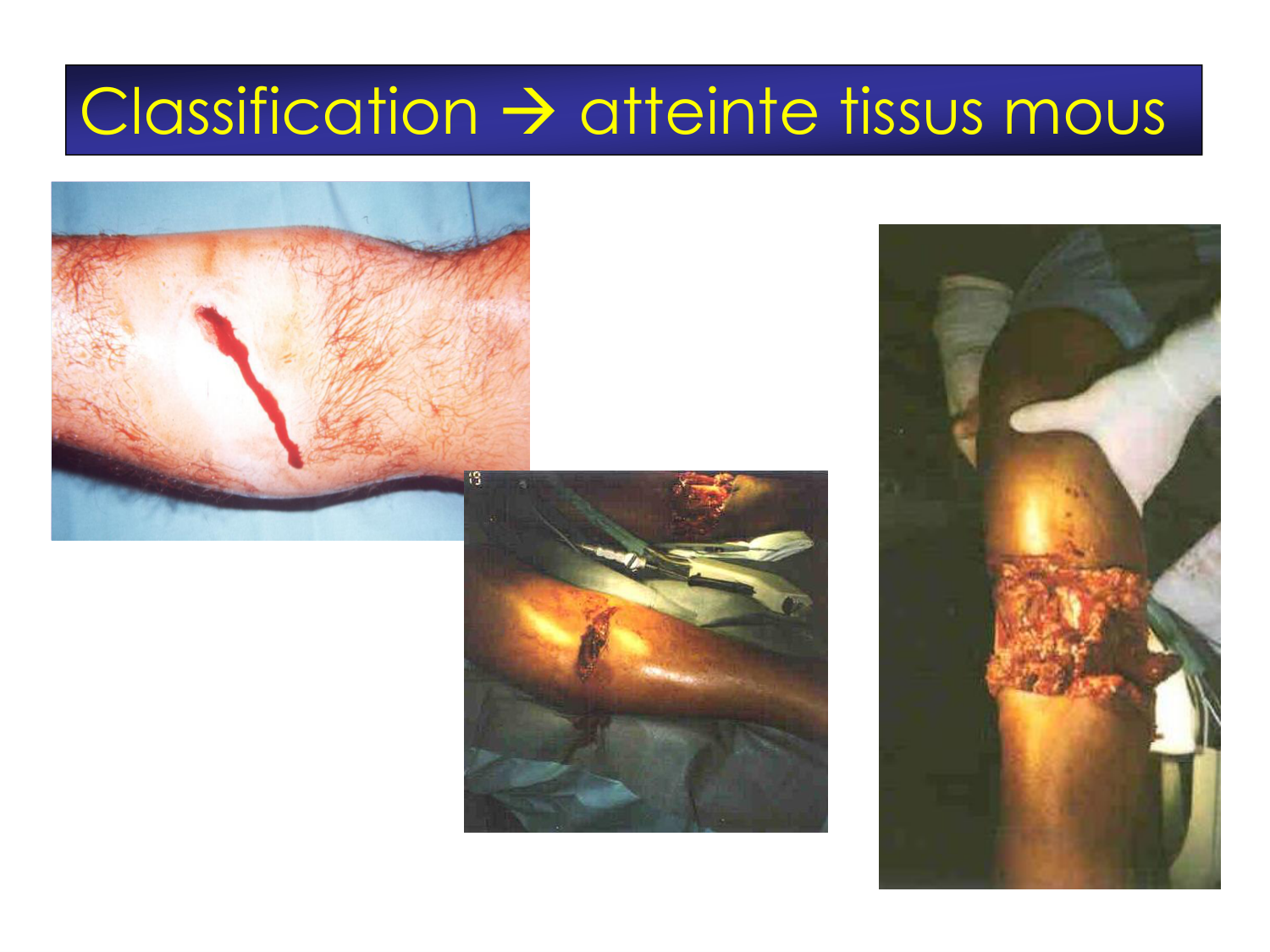 Fractures et réparation page 26