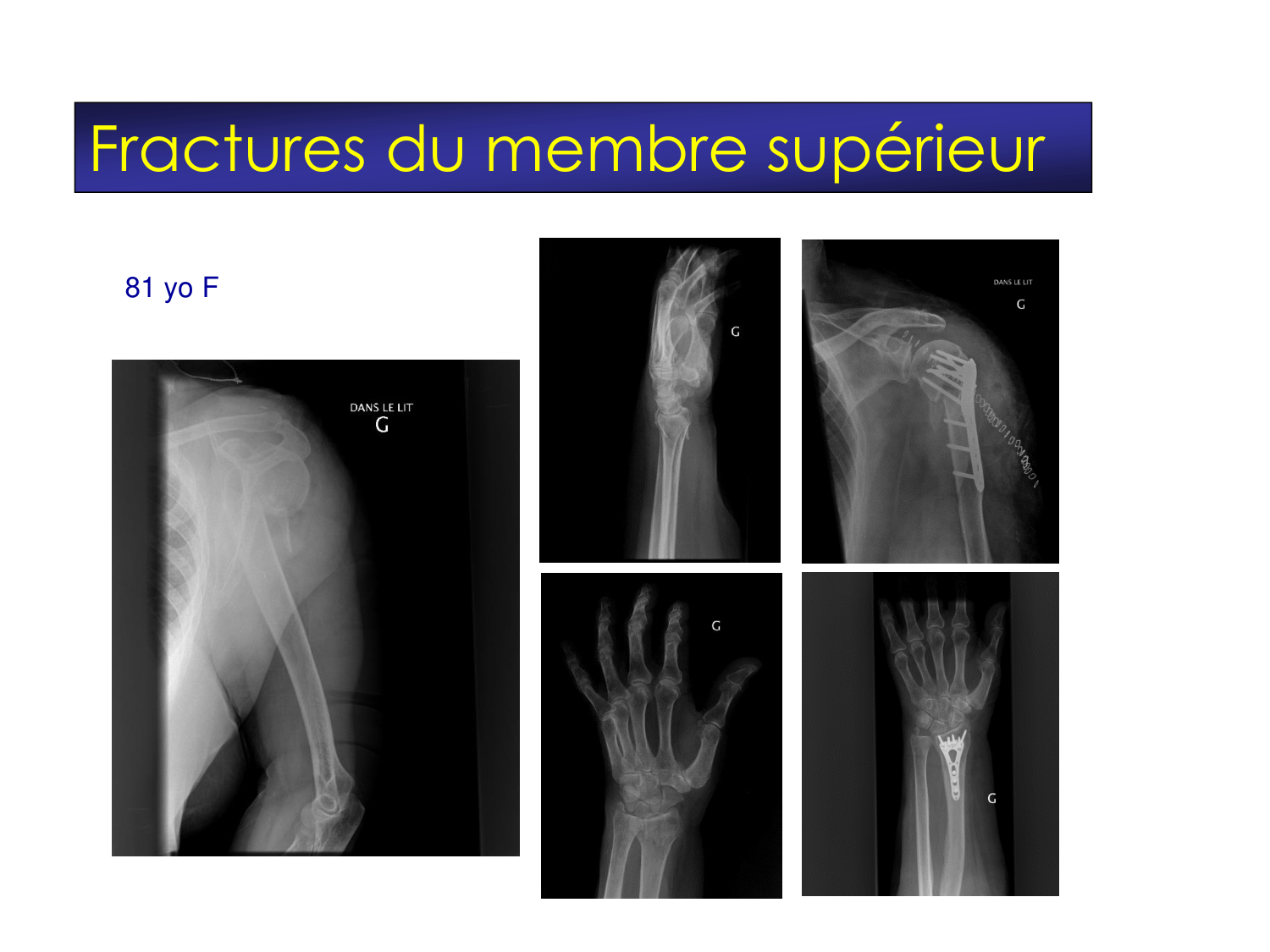 Fractures et réparation page 31