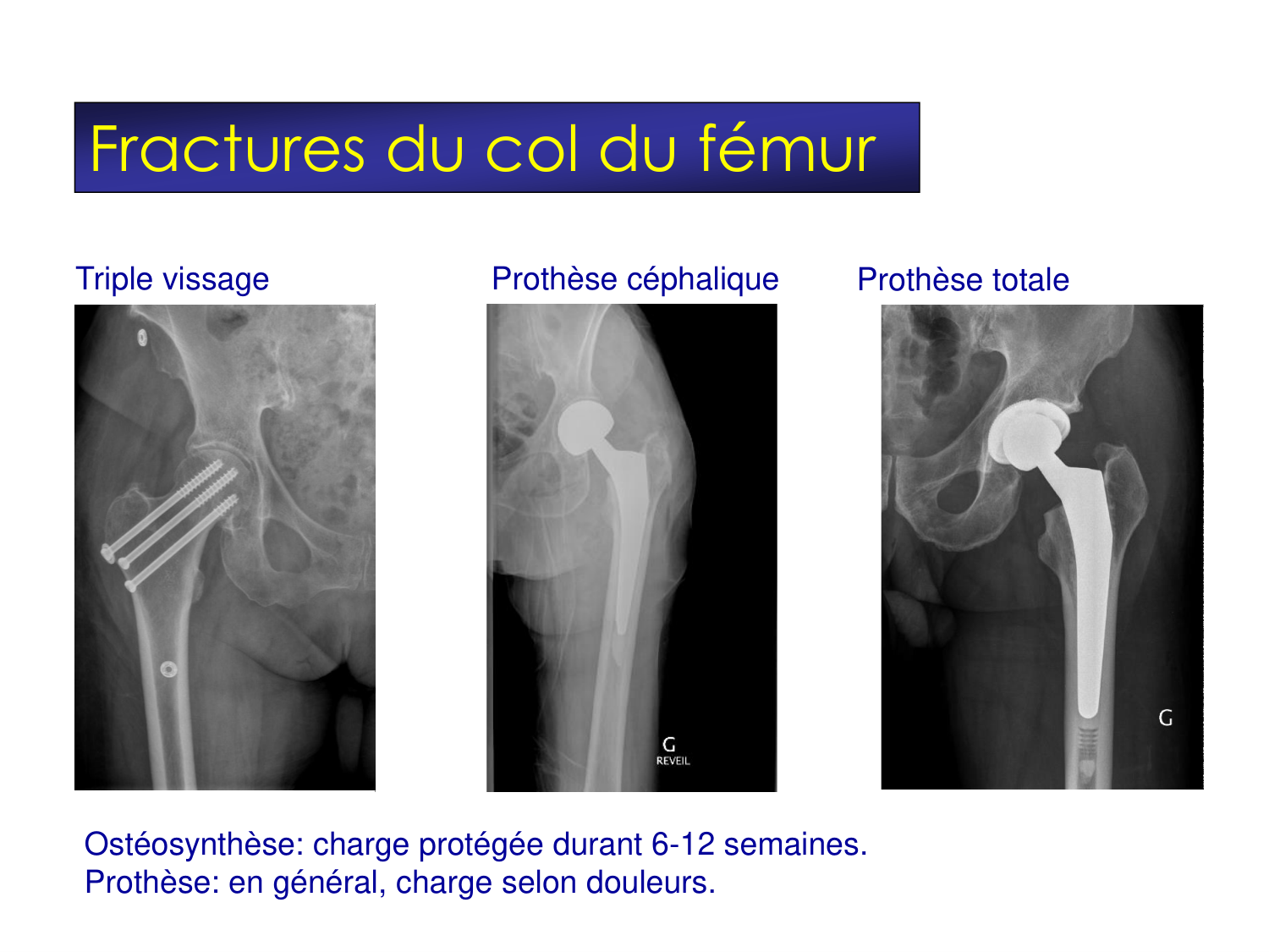Fractures et réparation page 33