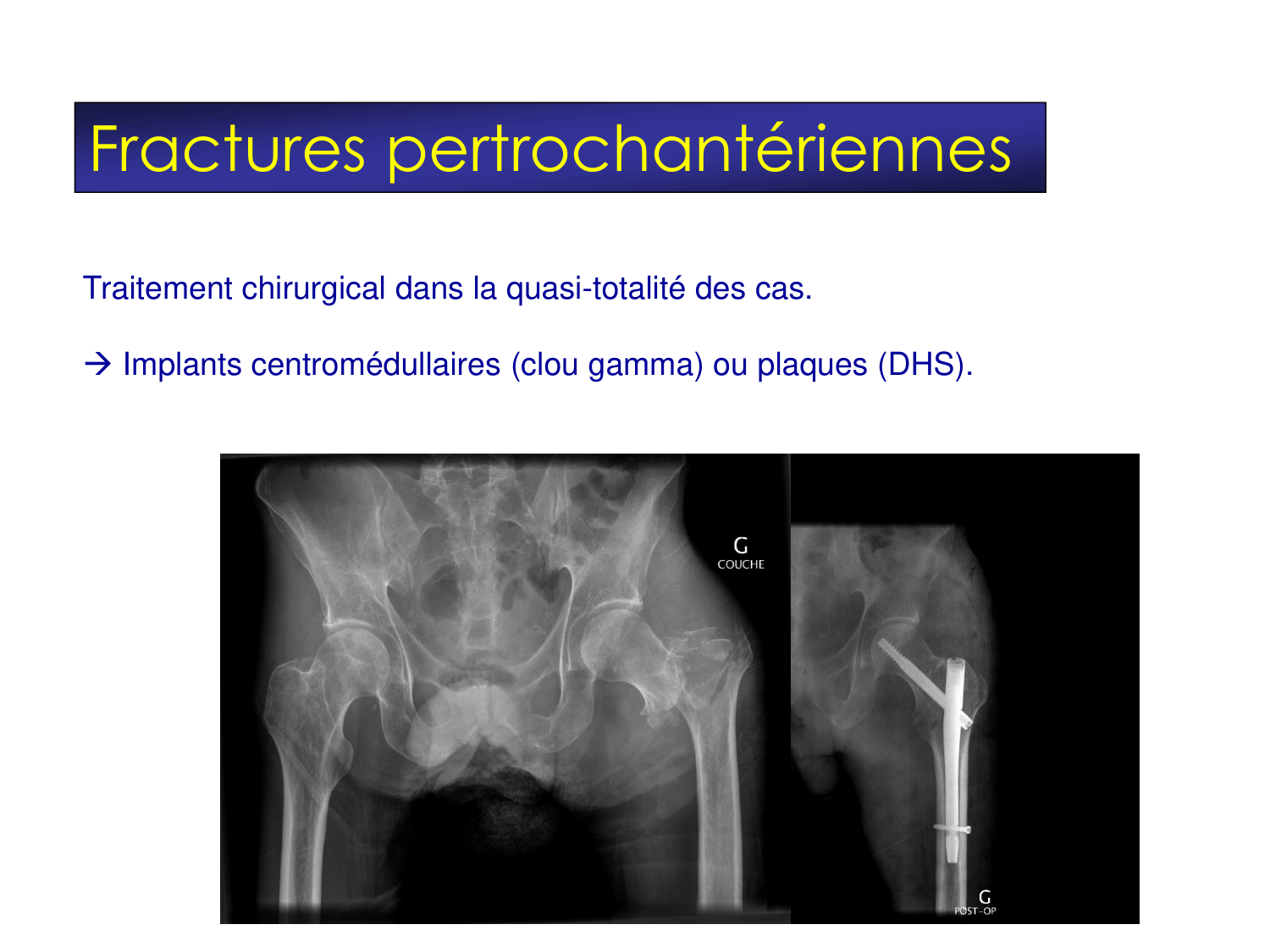 Fractures et réparation page 34