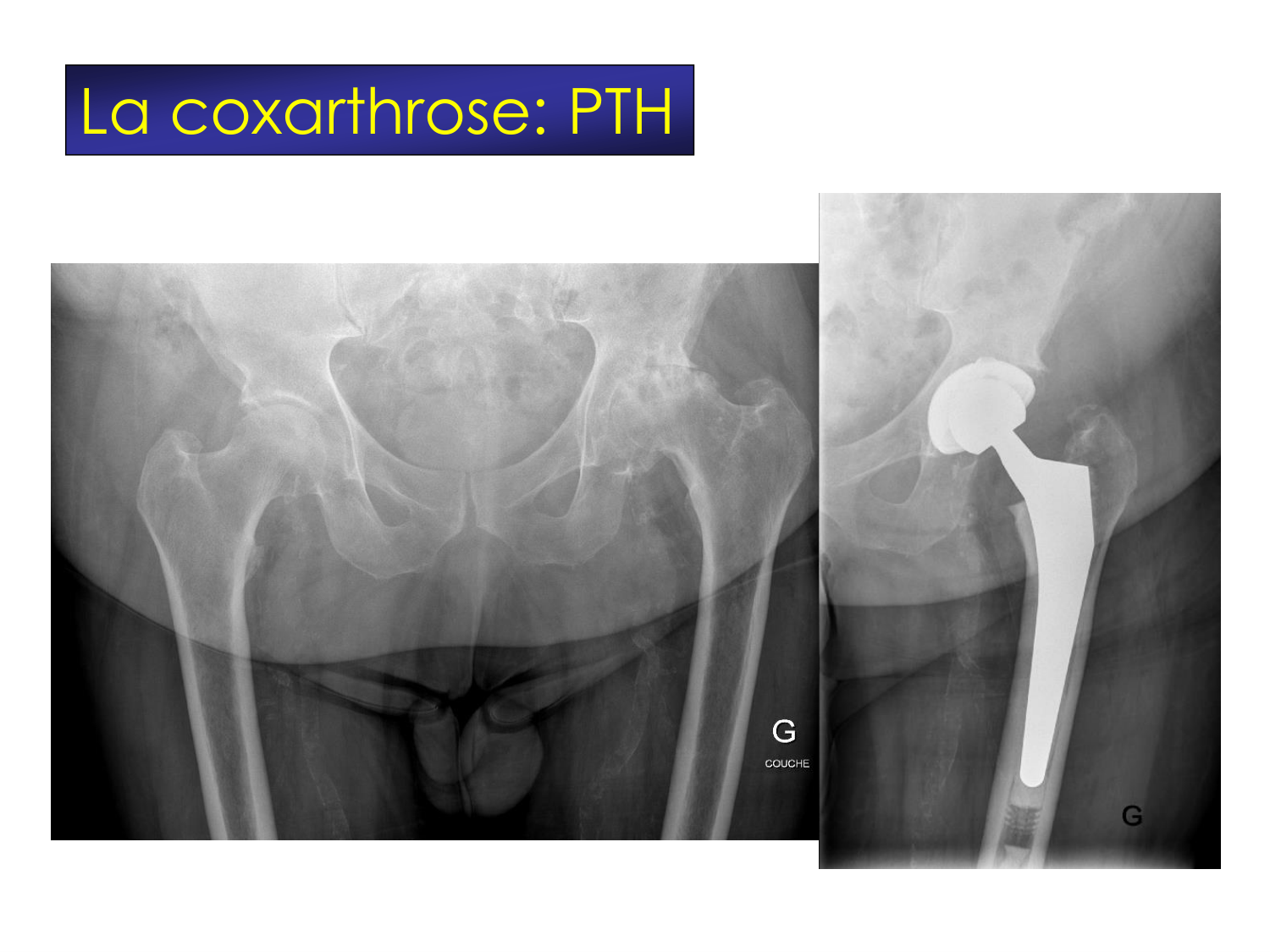 Fractures et réparation page 66