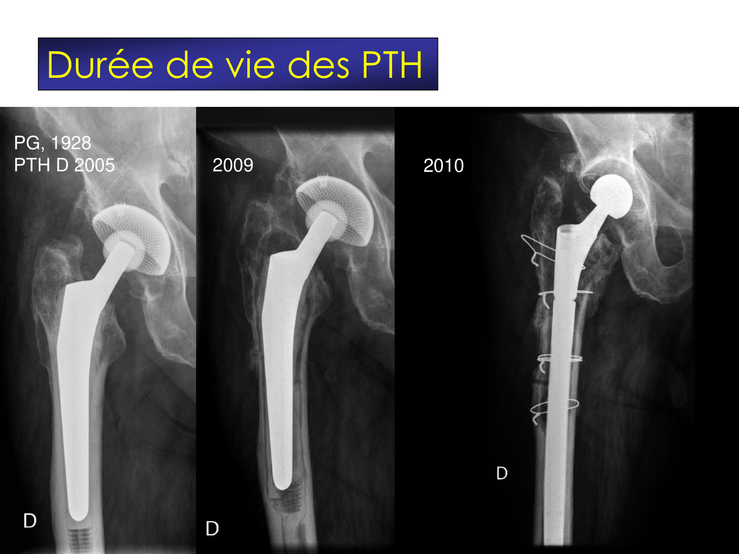 Fractures et réparation page 69